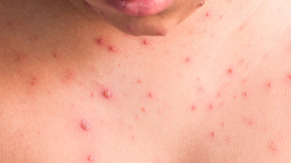 Chicken pox rash