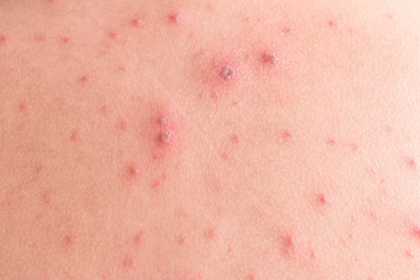 Exantema de varíola — Fotografia de Stock