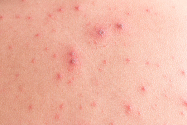Chicken pox rash