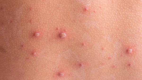 Chicken pox Images - Search Images on Everypixel