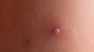 Kızamık döküntü