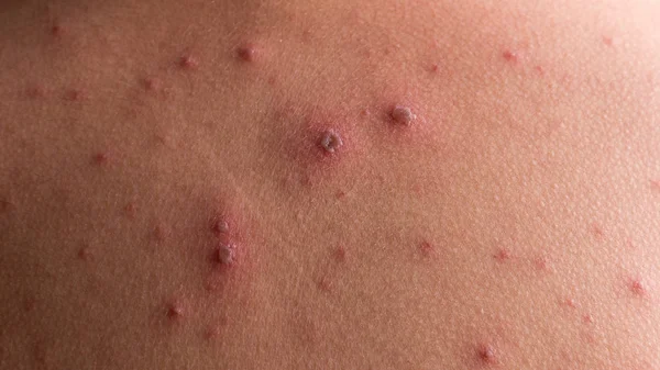 Chicken pox rash — Stock Photo, Image