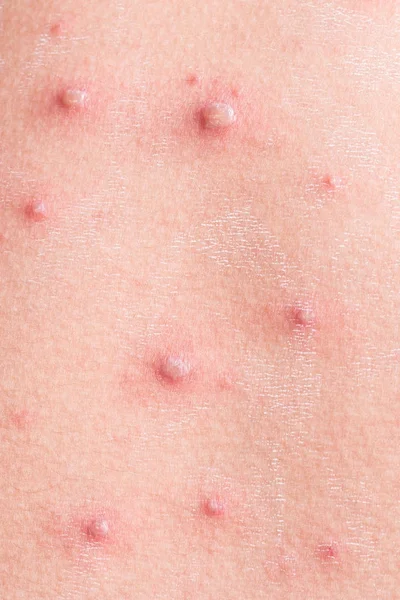 Allergic rash dermatitis eczema skin — Stock Photo © panxunbin #17995667