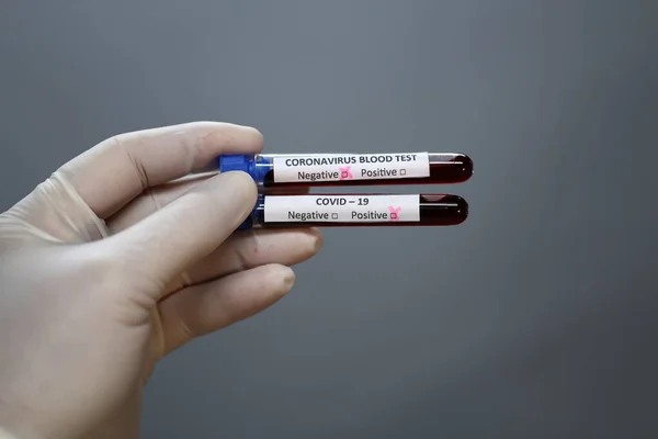 Testování Koronaviru Ruka Drží Zkumavky Obsahující Vzorky Pacientů Kterých Byly — Stock fotografie