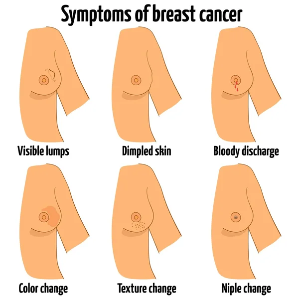 Симптоми раку молочної залози. Векторні ілюстрації . — стоковий вектор