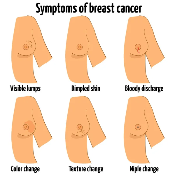 Brustkrebs-Symptome. Vektorillustration. — Stockvektor