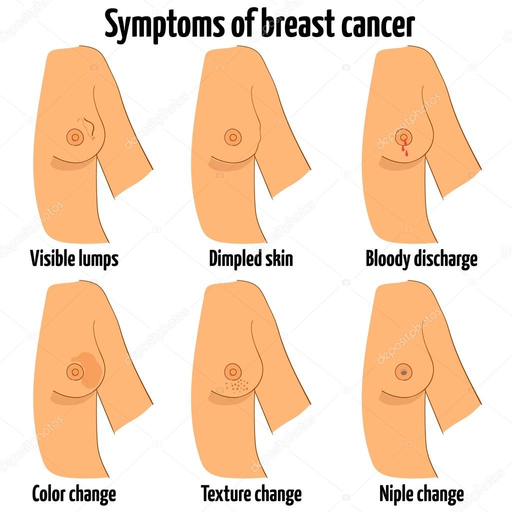 Breast cancer symptoms. Vector illustration.