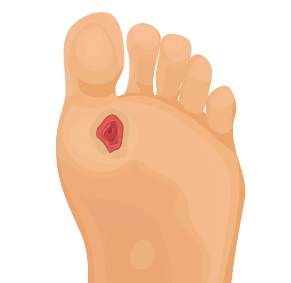 Ulcère diabétique sur pied humain illustration vectorielle — Image vectorielle