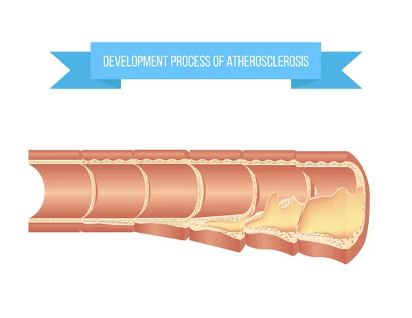 Proceso de aterosclerosis en diferentes etapas — Vector de stock