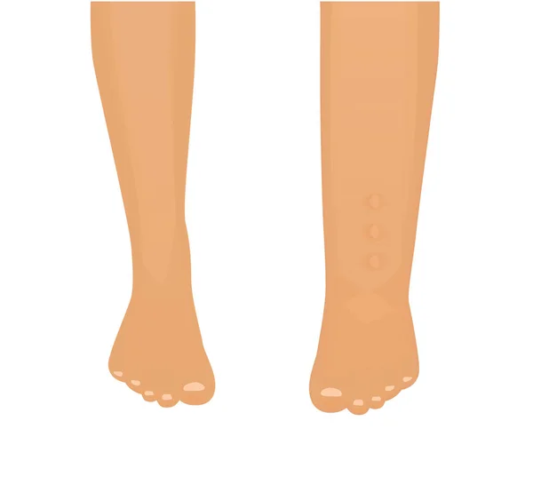 Edema ilustração vetorial. Perna normal com perna com edema —  Vetores de Stock