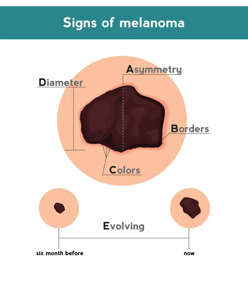 Melanoma signos ABCDE. Ilustración vectorial del parche cutáneo con cáncer de piel — Archivo Imágenes Vectoriales