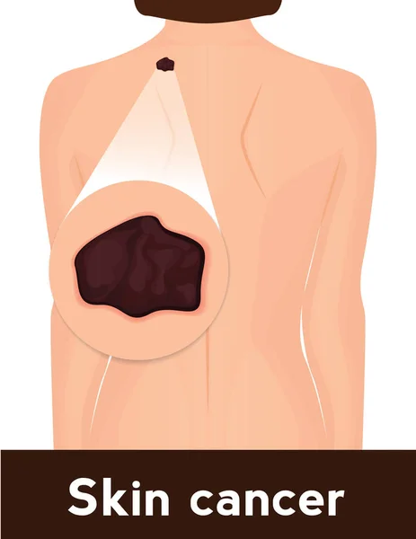 Skin cancer medical poster. Illustration of woman with malignat mole — Stock Vector