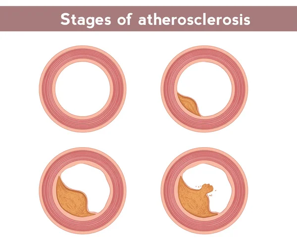 Étapes de l'athérosclérose. Développement de l'athérosclérose dans la lumière du vaisseau — Image vectorielle