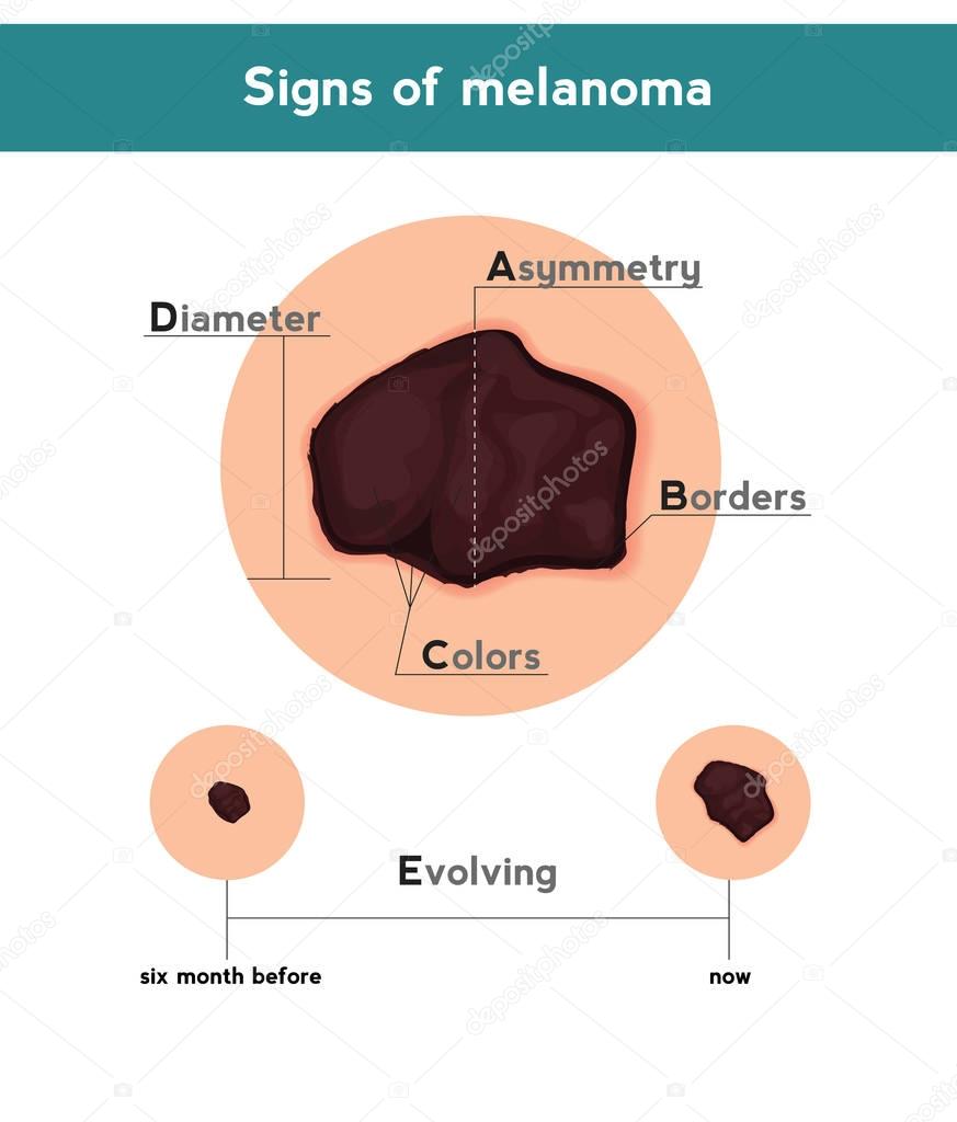 Melanoma ABCDE signs. Vector illustration of skin patch with skin cancer