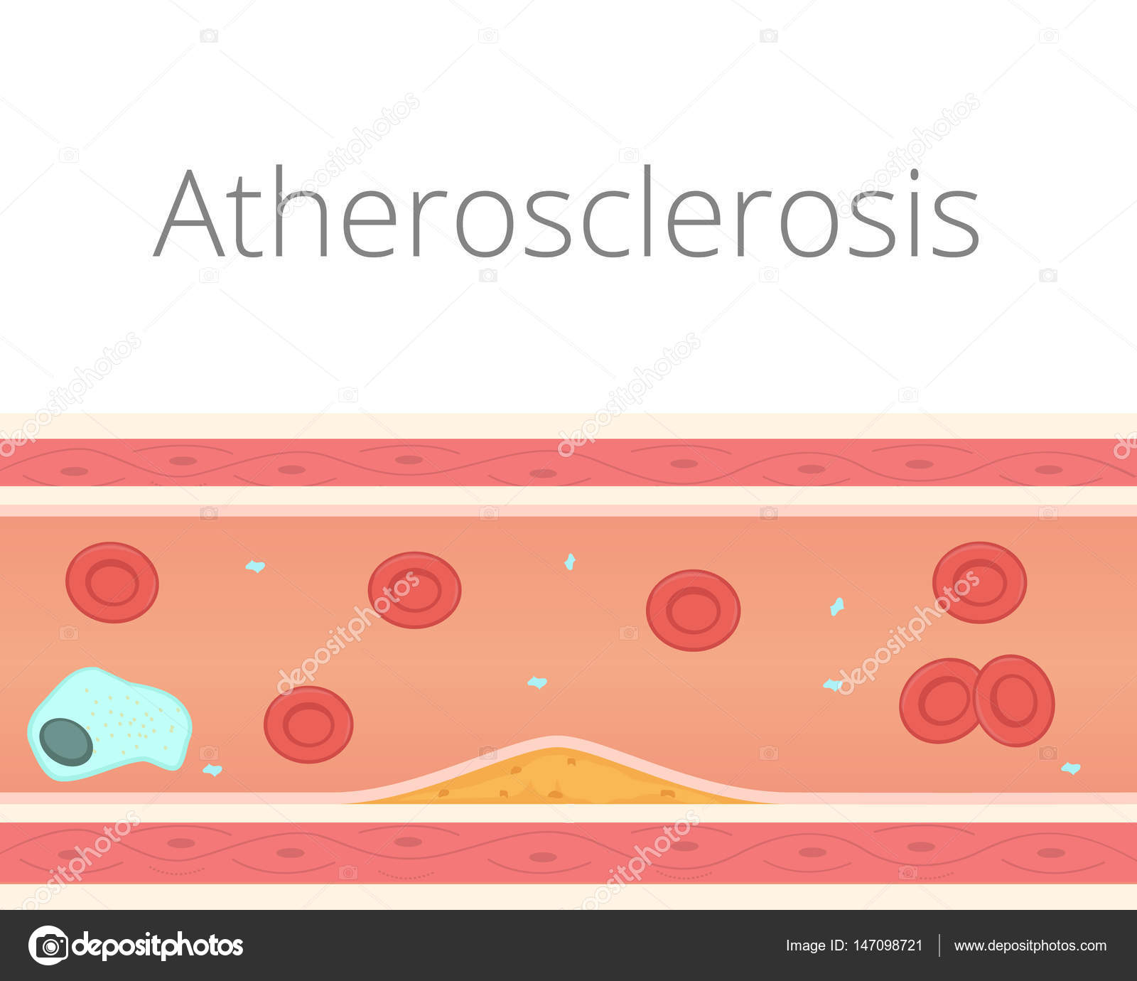 ディズニー画像のすべて 100 Epic Best動脈 硬化 イラスト