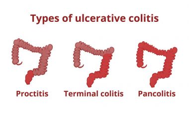 Types of ulcerative colitis vector illustration clipart