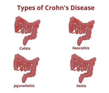 Crohn hastalığı anatomi sınıflandırma