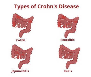 Crohn's disease anatomy classification clipart