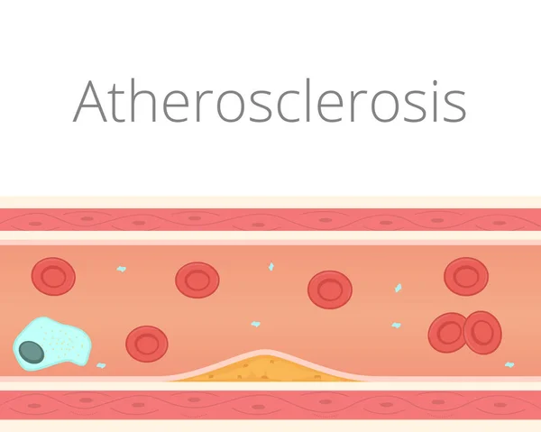 Atherosclerosis vector illustration. Atherosclerotic plaque in the lumen of the vessel — Stock Vector