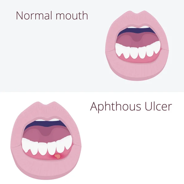 Ağız Ülseri vs normal ağız. Aftöz Stomatit vektör çizim — Stok Vektör