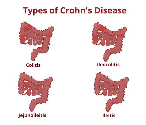 Crohn's disease anatomy classification — Stock Vector