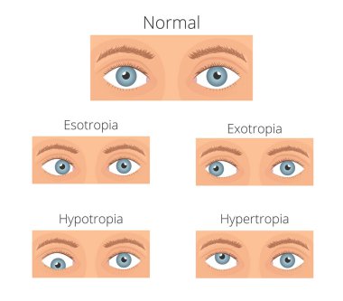 Strabismus vector illusration. Types of crossed eyes clipart