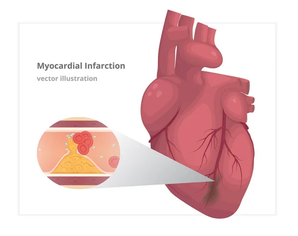 Myocardial infarction vector illustration. Cardiac infarct — Stock Vector