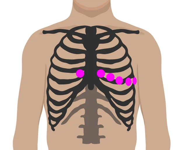 El pecho lidera la colocación. Posición del electrodo Ecg — Archivo Imágenes Vectoriales