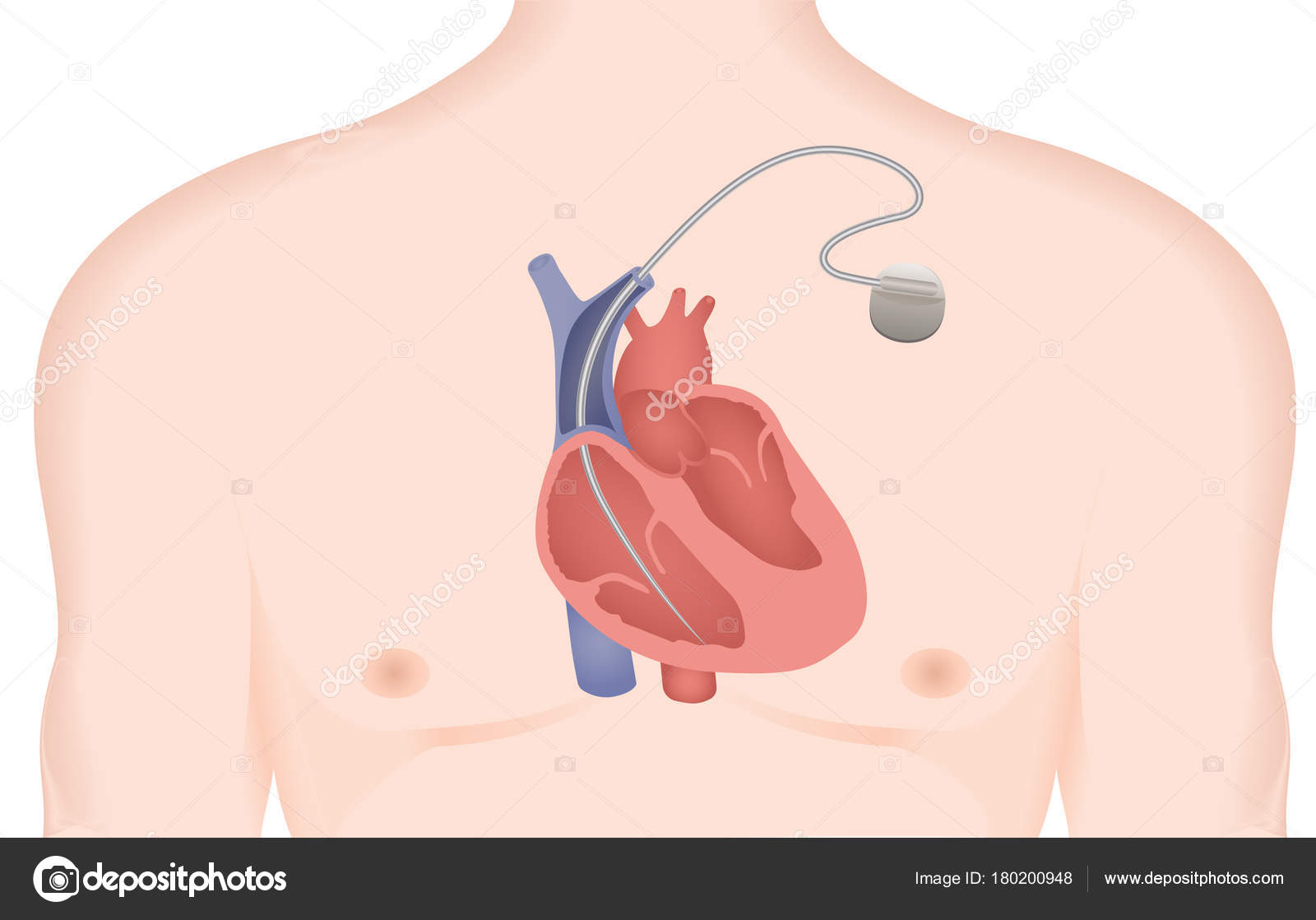 desfibrilador cardioversor implantable
