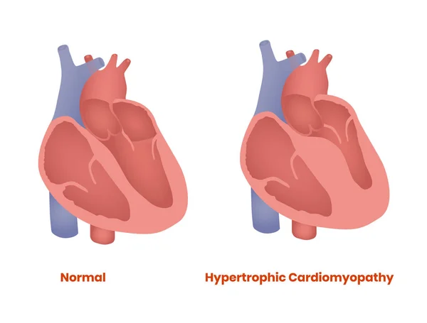 Corazón normal y corazón hipertrófico. Ilustración vectorial de miocardiopatía hipertrófica — Vector de stock