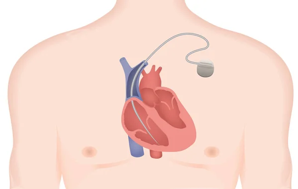 Illustrazione artificiale del vettore del pacemaker cardiaco. Defibrillatore cardioverter impiantabile — Vettoriale Stock