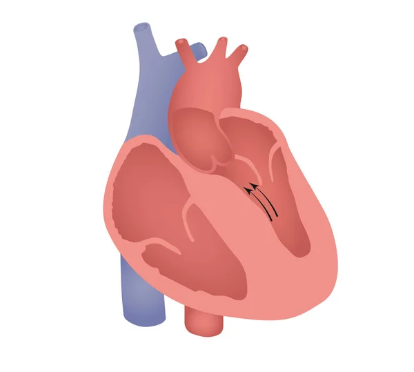 Non-obstructive septal cardiomyopathy illustration — Stock Vector