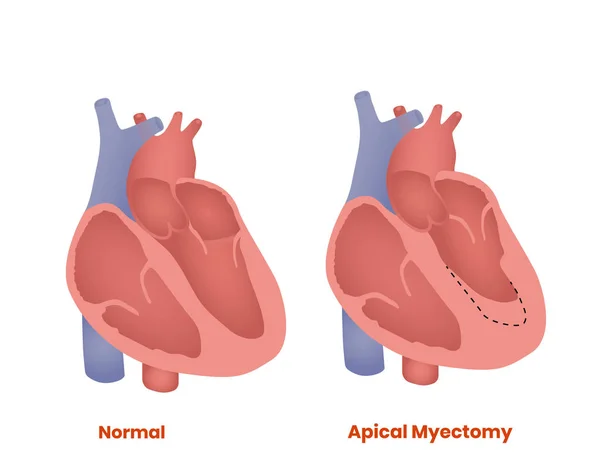 Miectomía apical. Tratamiento de la miocardiopatía hipertrófica — Vector de stock