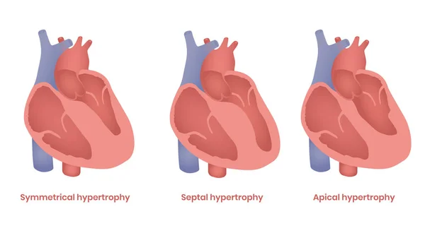 Hypertrofische cardiomyopathie illustratie. Apicaal, septal en symmetrische typen — Stockvector