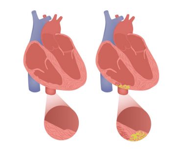 Healthy heart with arrhythmogenic cardiomyopathy. Vector illustration of arrhytmogenic right ventricular dysplasia clipart