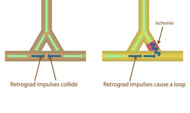 Yeniden giriş illüstrasyon. Kardiyak aritmi mekanizması