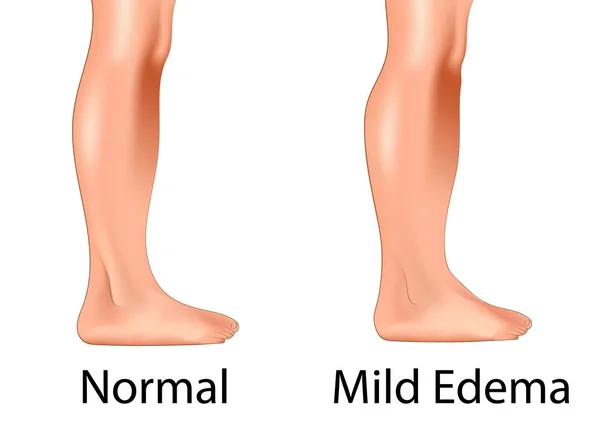 Edema leve con pierna normal — Vector de stock