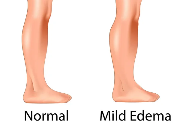 Edema ligeiro com a perna normal — Vetor de Stock