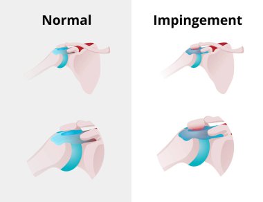 Normal shoulder and impingement. Illustration of the normal shou clipart
