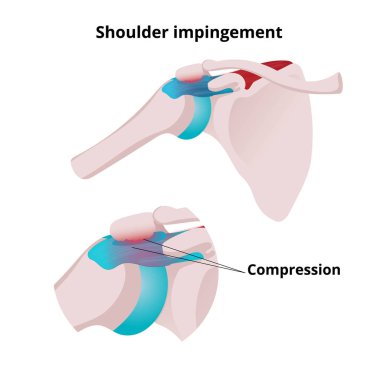Shoulder impingement vector illustration. Illustration of the mu clipart