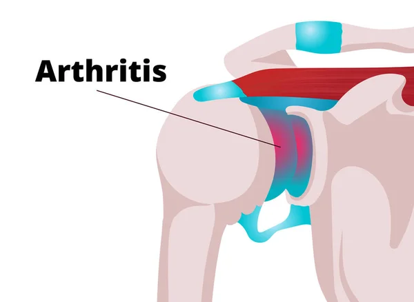 Shoulder arthritis vector illustration — Stock Vector