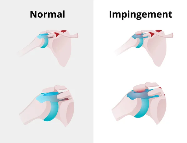 Normal shoulder and impingement. Illustration of the normal shou — Stock Vector