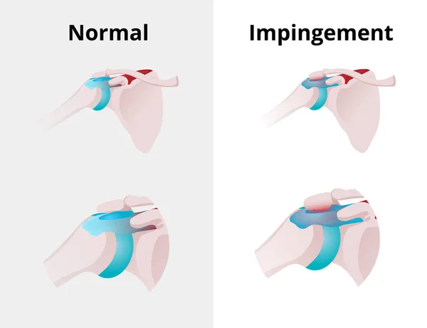 Normale Schulter und Impingement. Illustration des normalen Shou — Stockvektor