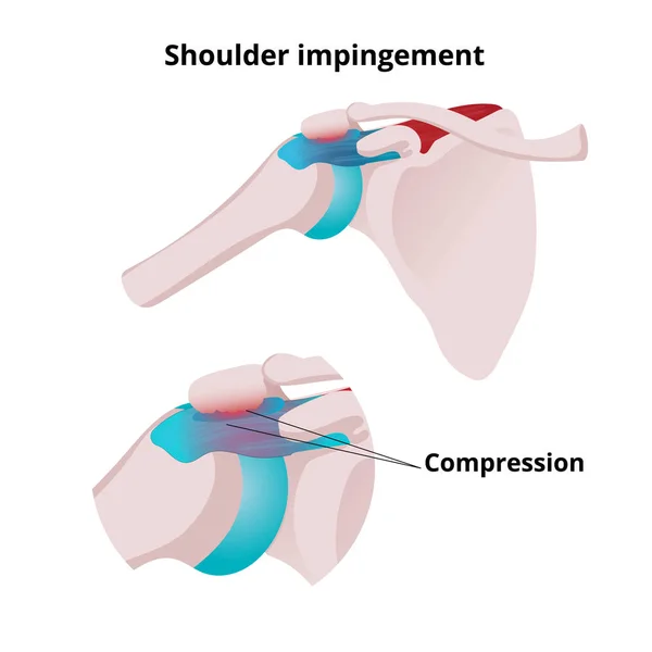 Shoulder impingement vector illustration. Illustration of the mu — Stock Vector