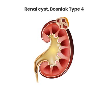 Basit renal kist vektör çizimi. Boşnak tipi 1