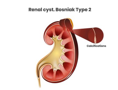 Basit renal kist vektör çizimi. Boşnak tipi 1