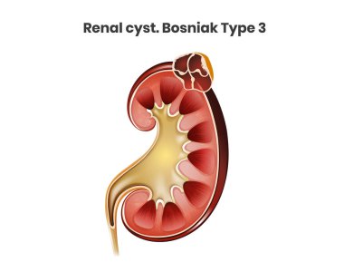 Basit renal kist vektör çizimi. Boşnak tipi 1