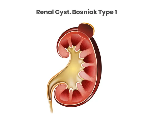 Enkel Renal Cysta Vektor Illustration Bosniak Typ — Stock vektor