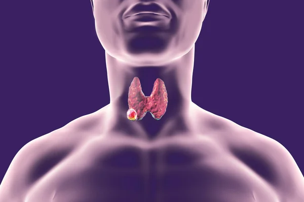 Cancer de la thyroïde. illustration — Photo