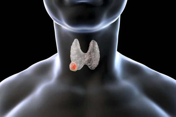 Thyroid cancer. illustration — Stock Photo, Image